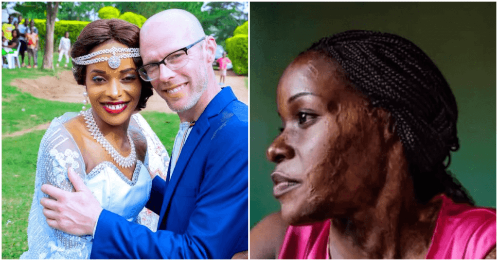 British man marries lady who suffered acid attack from ex-lover