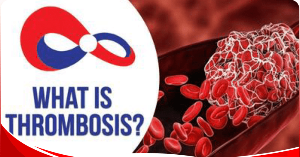 Five common myths around blood clots/thrombosis