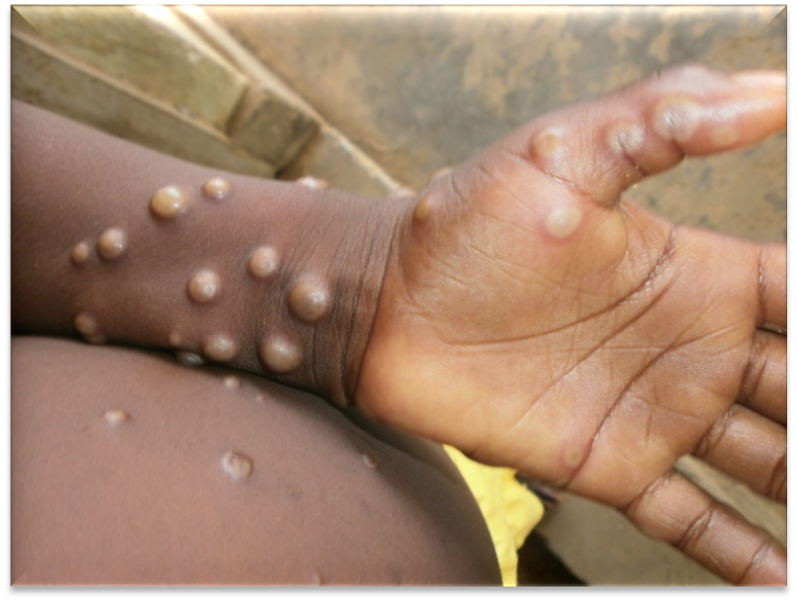 Kenya to roll out MPOX vaccination in December