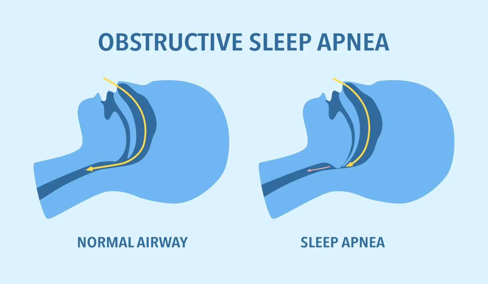 Regulators approve first drug treatment for obstructive sleep apnea