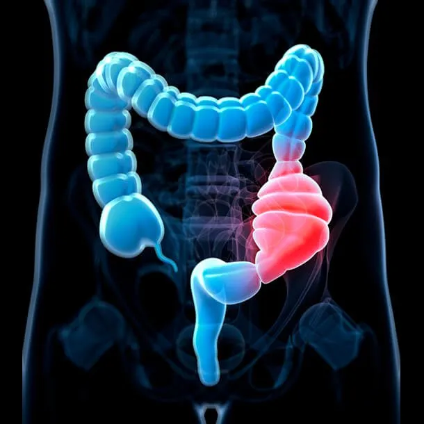 What you need to know about colorectal cancer